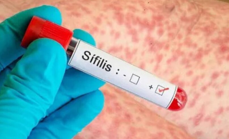 Sífilis: Argentina registró más de 46.000 casos en 2025